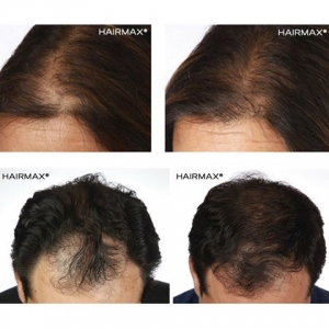 laser hair loss treatment new orleans