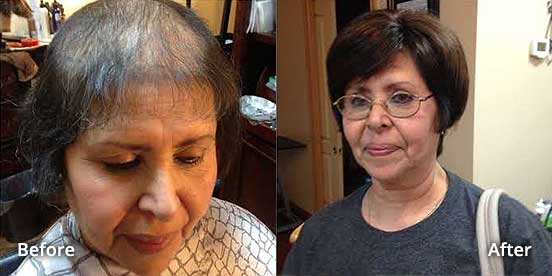 Women's Hair Replacement Solutions for Thinning Hair - New Orleans - Kenner, LA