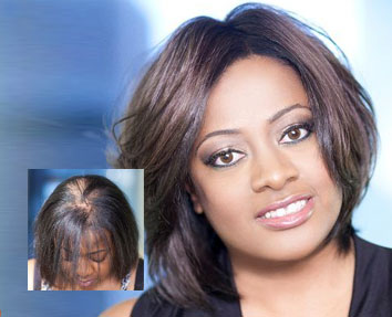 female hair loss replacement new orleans la